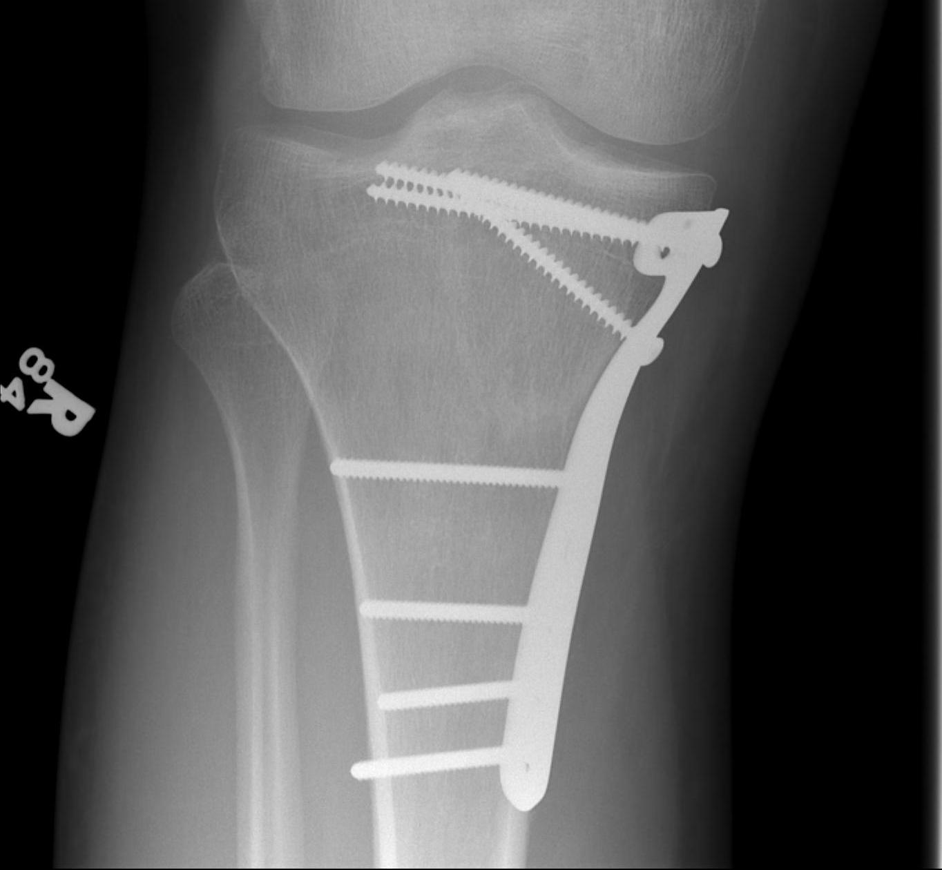 Schatzker 4 Medial Plate0001